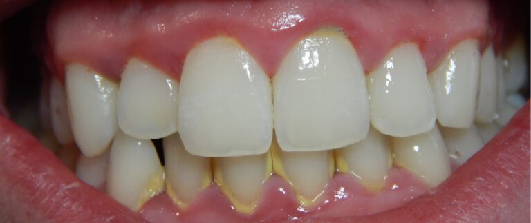 Gingivitis before and after 3 1 scaled