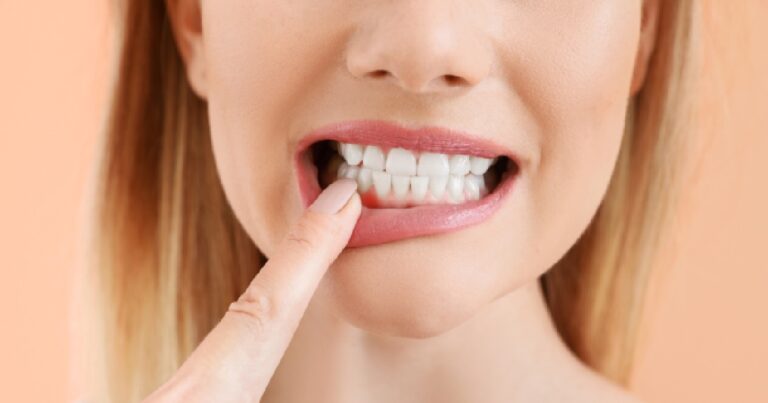 recessione gengivale 1