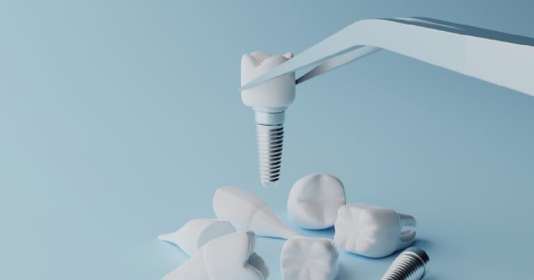 impianto dentale 1