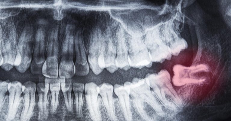pericoronite dente giudizio