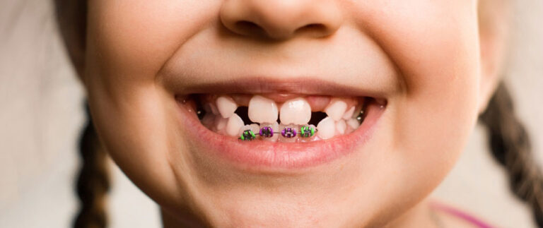 apparecchio dentale bambini 1