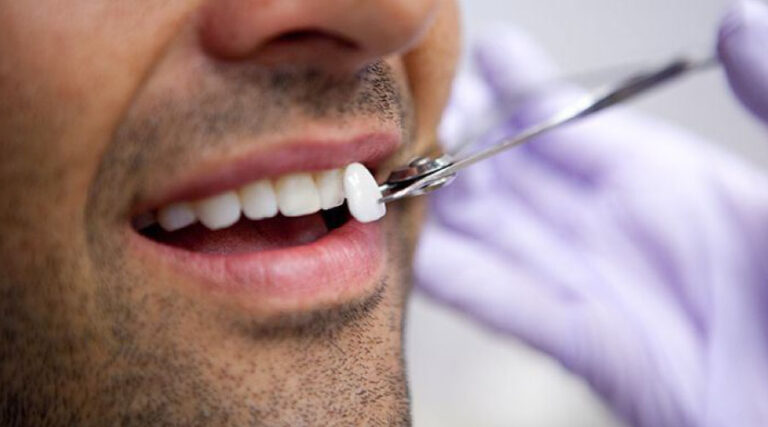 faccette dentali estetiche 1